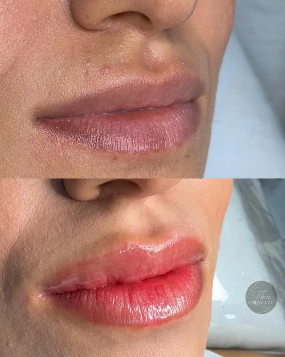 Antes e depois de revitalização labial masculina, cor e contorno naturais