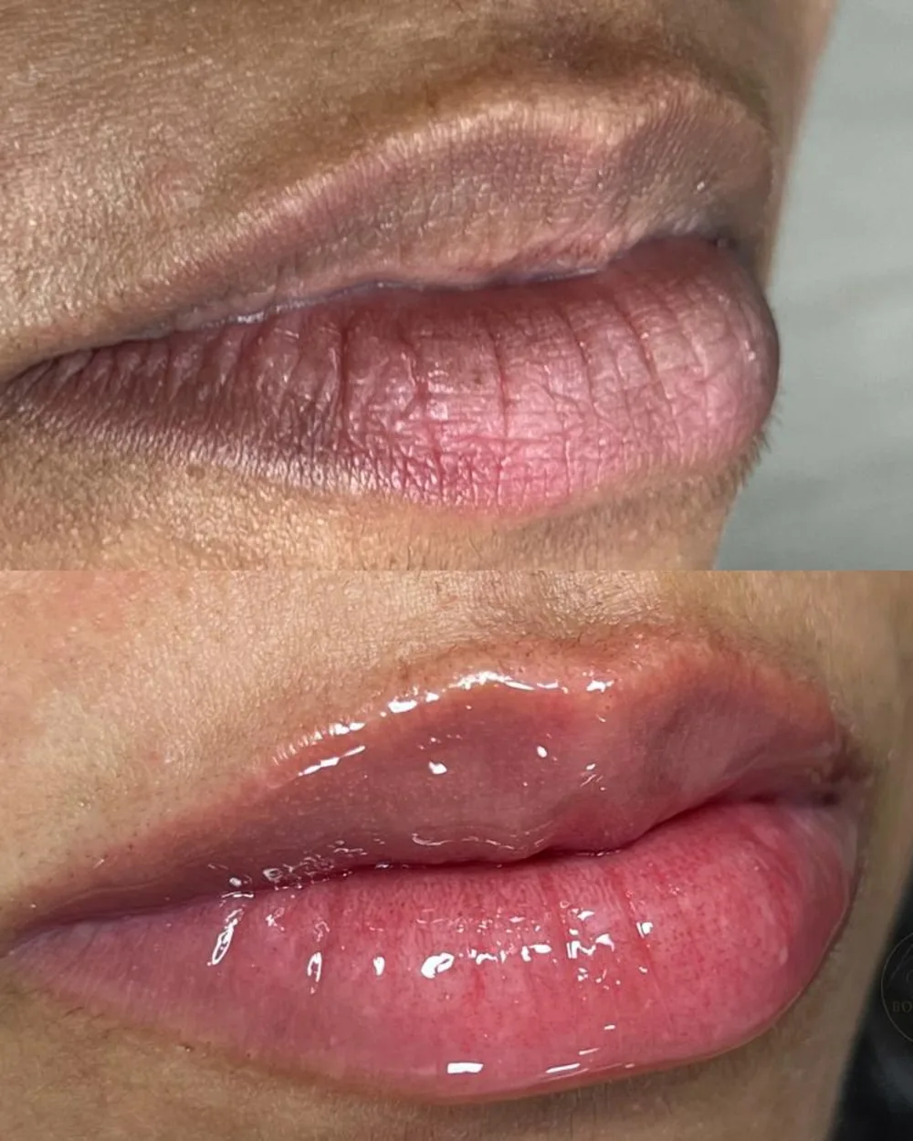 Antes e depois de neutralização labial, uniformizando o tom dos lábios com resultado natural