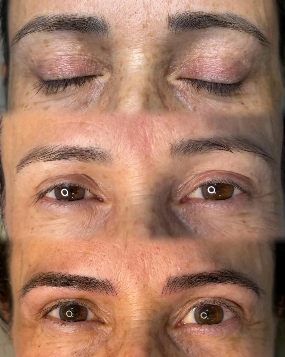 Antes e depois de correção e remoção de sobrancelha em etapas, resultado natural