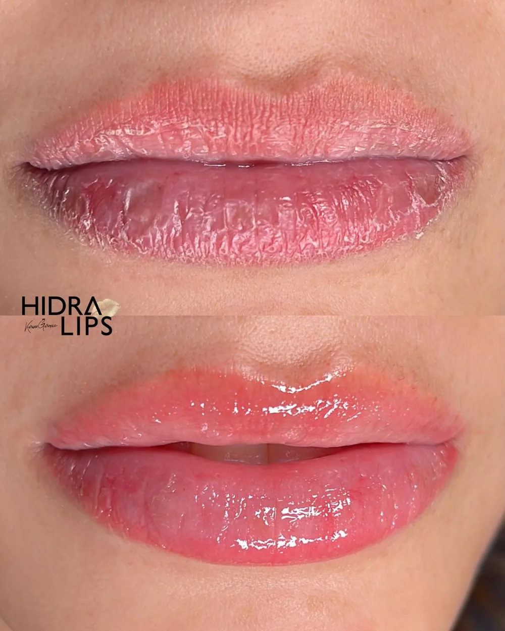 Antes e depois de Hidra Lips, lábios com volume, hidratação e brilho natural